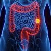 Revealed: The 20-minute routine developed by doctors that may help PREVENT bowel cancer as cases continue to surge