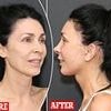 I underwent a facelift ahead of my son's wedding... but it is now being branded as 'too perfect'
