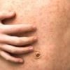 Measles holiday warning as cases rise in Europe