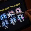 FDA OKs first blood test that can help diagnose Alzheimer's disease