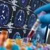 Alzheimermedicijn krijgt groen licht voor Europese markt