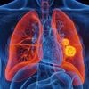 Cancer : une nouvelle molécule pour lutter contre les métastases résistantes aux traitements