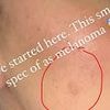 Expert warns of 6 early signs of deadliest skin cancer everyone MUST know