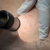 Langzeitschäden durch UV: Wesentlich mehr in Kliniken behandelte Hautkrebsfälle