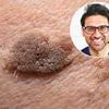 How to remove crusty brown skin patches and warts at home. Doctors often won't treat these unsightly growths. Now our experts reveal what really can help... and when to be concerned about cancer