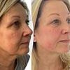 Revealed: The women who look 10 years younger WITHOUT Botox and credit non-invasive procedures for their incredible transformations