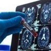 Alzheimer's blood test could 'revolutionise' diagnosis