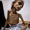 Gaza's living skeleton: Young Palestinian girl is reduced to skin and bone amid food crisis - as Israel calls for action over starved hostage video