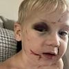 First-day nightmare as boy is left bruised and battered by 'classmate'... then parents watched security footage